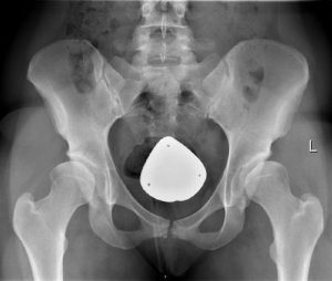 Hip-dysplasia